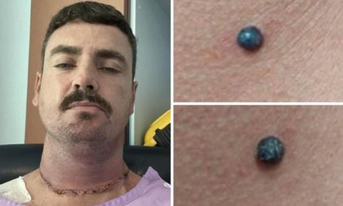 Tradie, 38, given six months to live after his HAIRDRESSER found a dodgy mole and pressured him to get it checked out by a specialist after doctors sent him home claiming 'it was nothing'