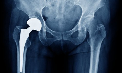 Gene test to tell if your hip surgery will fail: Saliva swab could predict if you'll have an adverse reaction to a joint implant