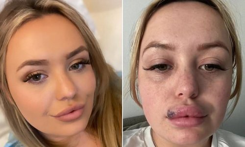 Mother, 25, was left with painful, blistered 'duck lips' after a severe allergic reaction when she had her filler dissolved without a patch test