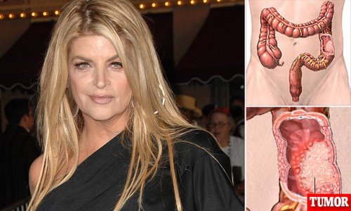Colon cancer, the 'silent killer' that claimed the life of Kirstie Alley: Disease grows with little or no symptoms and will strike one in TWENTY Americans in their lifetime