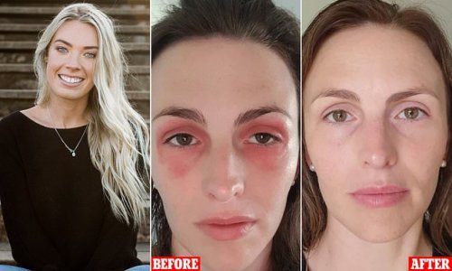 Woman struggling with painful rashes and swelling from her auto immune disease clears up her face in FOUR weeks using one 'miracle' cleanser