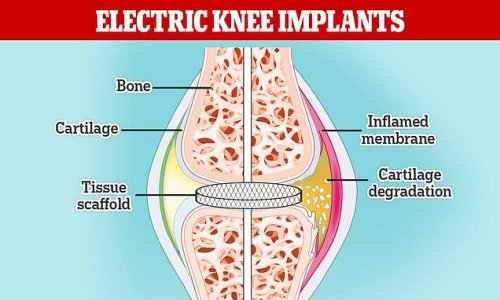 Electric KNEE implants could be the answer for millions of arthritis sufferers after scientists find a way to regrow cartilage with the help of a tiny electrical current
