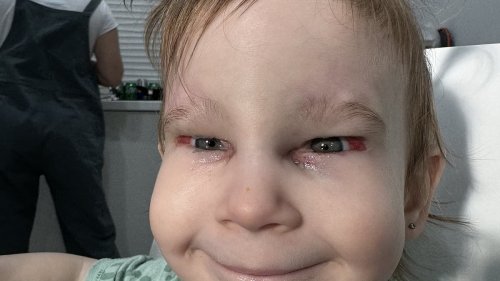 Toddler can see clearly for the first time after surgery to open her eyes fully - and her delighted...