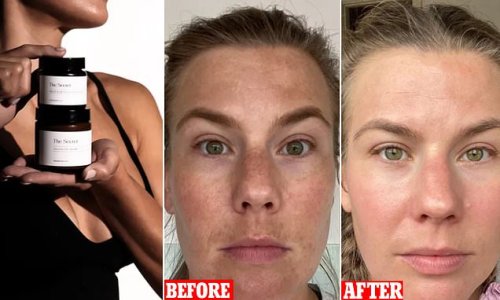 Woman reveals the 'secret weapon' that transformed her severe pigmentation in just six weeks: 'I'm glad I took pictures or I wouldn't believe it'