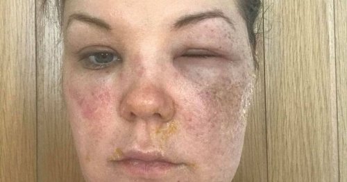Loose Women egg hack explodes in mum's face as she suffers 'excruciating' burns