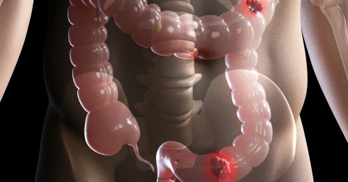 Bowel cancer warning signs and symptoms you should never ignore