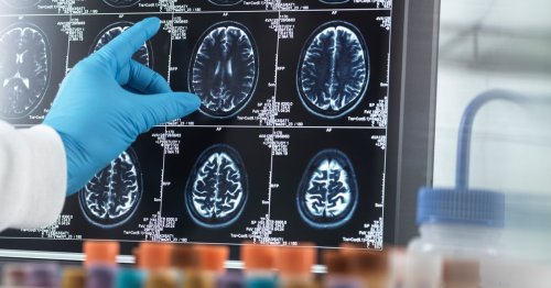 Alzheimer's may be 'prevented' in those 'destined' to develop dementia with new drug