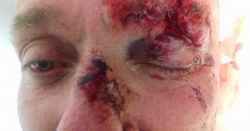 Yobs leave Good Samaritan covered in blood with fractured eye socket