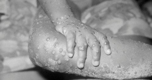 Monkeypox rules, symptoms, and risks as UK cases rise to 57