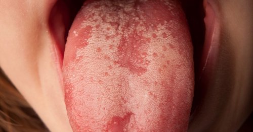 13 warning signs and symptoms on your tongue that you should never ignore