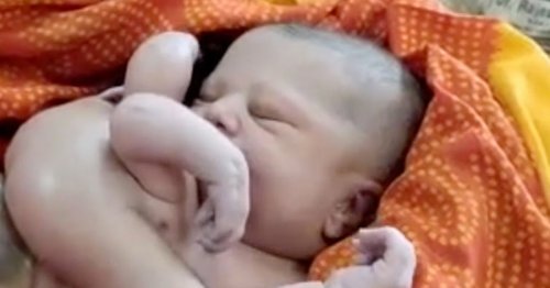 Baby born with four arms and legs now local celeb as people flock to see infant