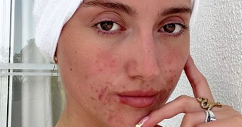 Woman with acne goes make-up free after men joke 'take her swimming on 1st date'