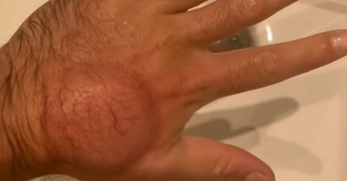 Boxer shows off 's***' he does to hands to avoid 'eating painkillers non-stop'