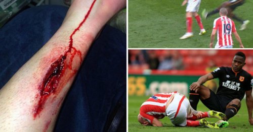 GRAPHIC CONTENT: Shocking photo shows damage done to Stephen Ireland after horror tackle