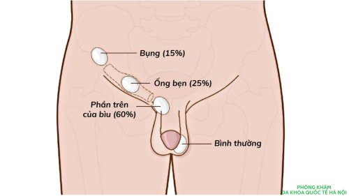 Tinh hoàn ẩn là gì? Mổ tinh hoàn ẩn ở đâu tốt nhất
