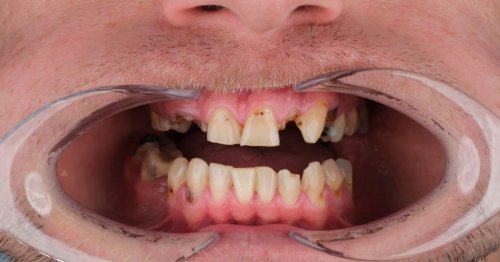 Man says 'stay away from energy drinks' after losing his teeth