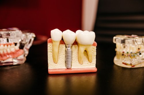 The Missing Wisdom Teeth Mystery: Why Some People Are Evolving Without Them - discoverwildscience