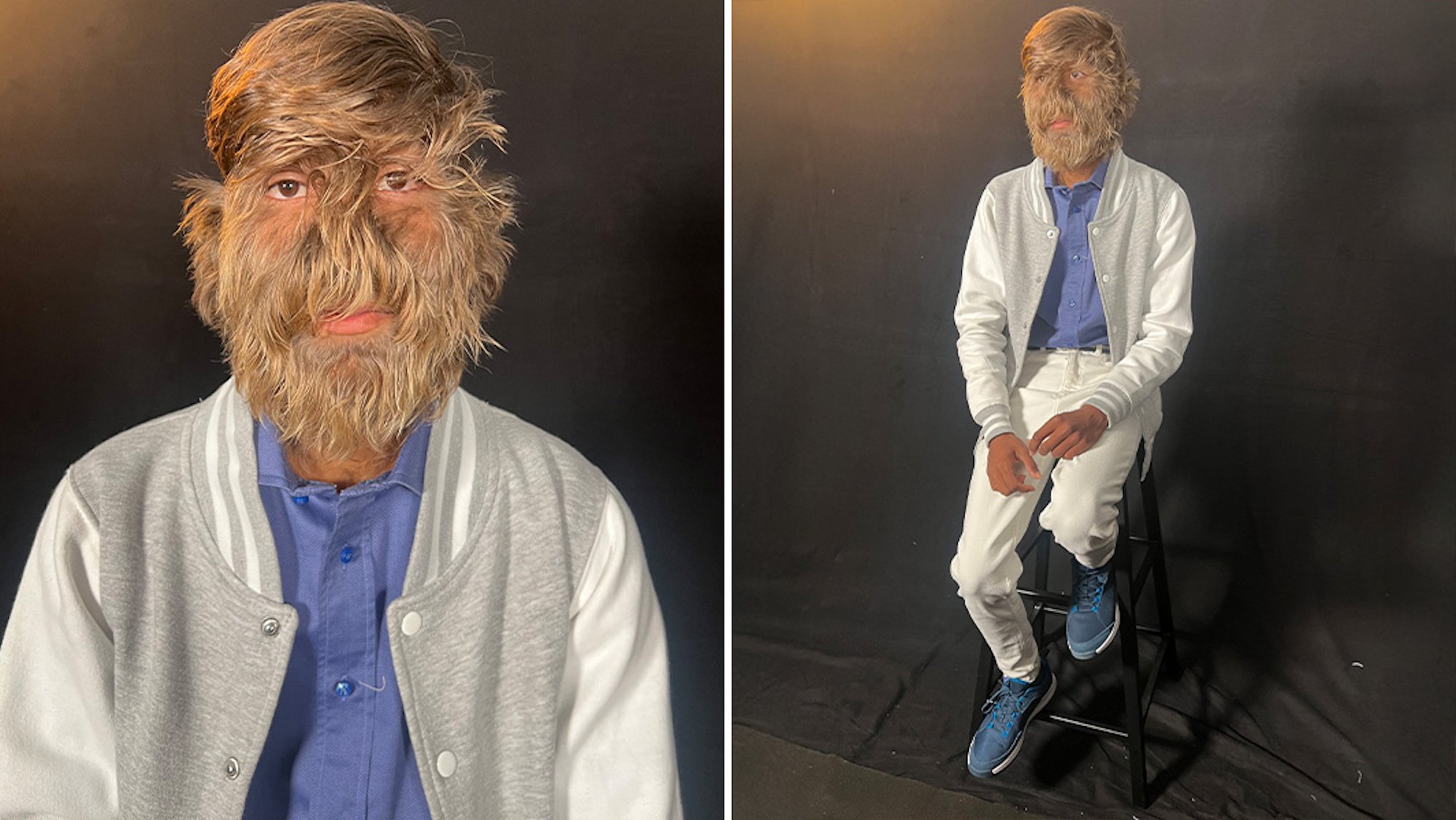 Atteint du syndrome du loup-garou, ce jeune homme de 18 ans possède le visage le plus poilu au monde !