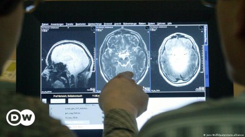 Alzheimer: Rätsel um absterbende Hirnzellen gelöst