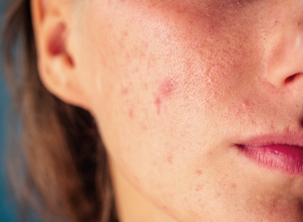 13 Foods That Make Your Skin Worse, According to Dermatologists