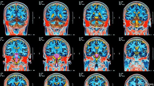 Studying broken chromosomes can illuminate neuroscience
