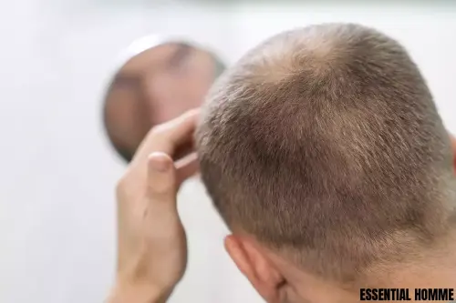 Le Nouveau Rôle Du Minoxidil Dans La Lutte Contre La Chute Des Cheveux - ESSENTIAL HOMME