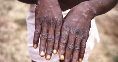 African scientists surprised by spread of monkeypox cases