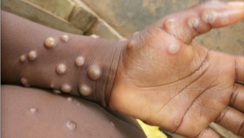 Monkeypox: What we know about the smallpox-like virus spreading in the UK