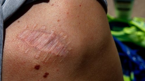 Zahl der Hautkrebspatienten hat sich fast verdoppelt