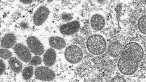 Hors Afrique, 80 cas de variole du singe recensés dans le monde