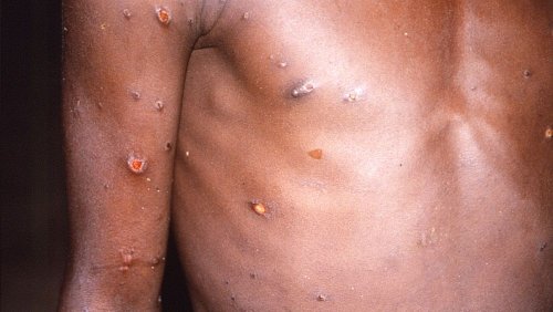 Monkeypox outbreak: Where has the smallpox-like virus spread so far?