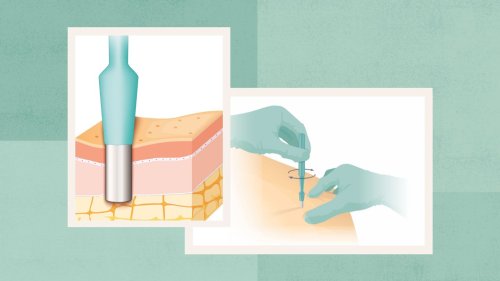 A Simple Skin Biopsy Can Accurately Detect Parkinson’s, Lewy Body Dementia, and Other Neurodegenerative Diseases