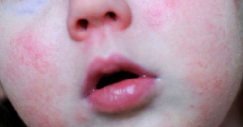 Leeds scarlet fever cases as city has second highest number of infections in the country