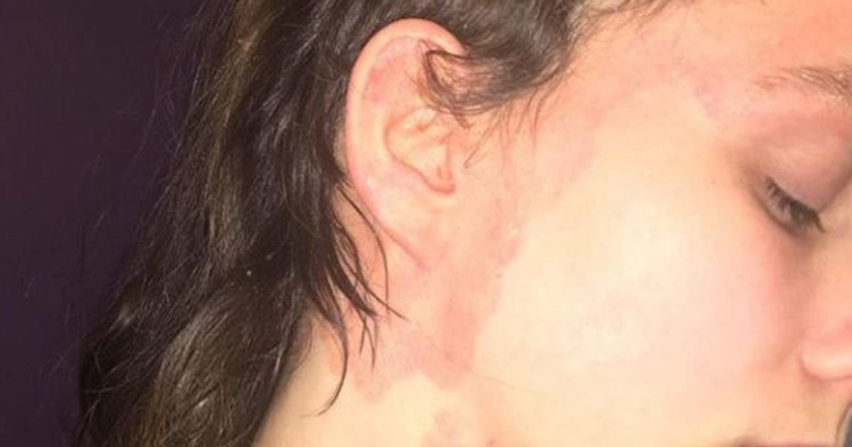 Woman with psoriasis says 'people stared' until £12 serum cleared skin in 2 weeks