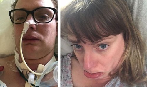 Mum-of-two left in coma after Covid jab now has rare condition