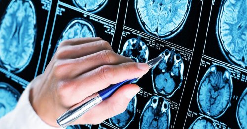 Les États-Unis valident le premier test sanguin de dépistage d'Alzheimer