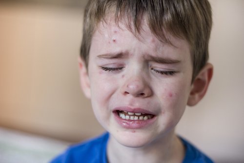 RFK Jr.’s Misleading Line on the Chickenpox Vaccine