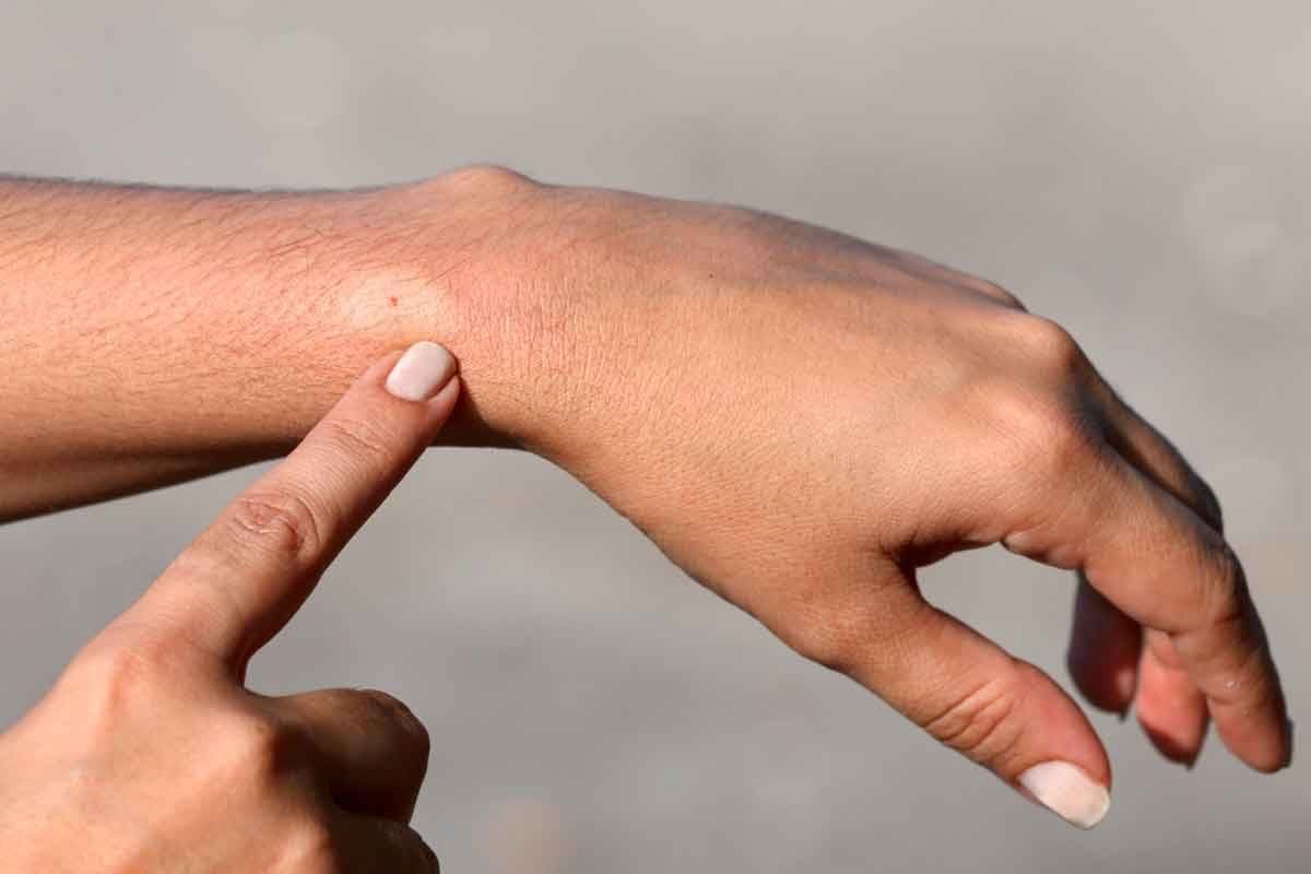 What to Do When a Wasp Stings You