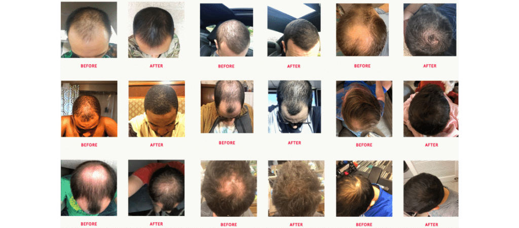 Men's Hair Loss Reviews - Compare Hair Loss Meds Online - cover