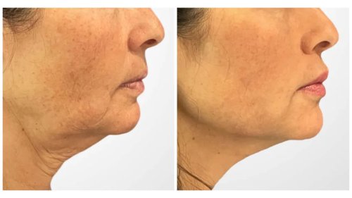 Thread Lift Before and Afters: See How It Works as Well as a Facelift in Just 30 Minutes