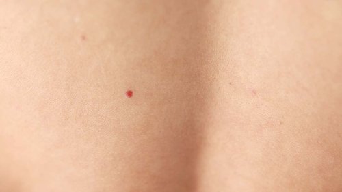 What Are Those ‘Red Moles’ on My Skin — And Are They Dangerous?