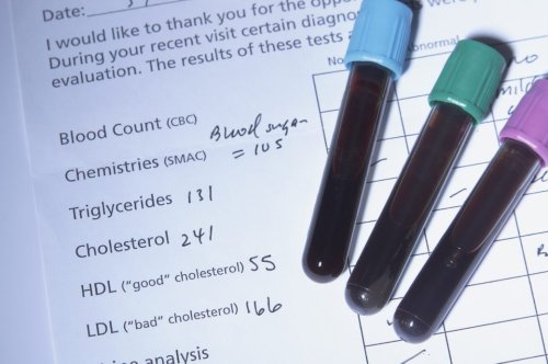 Worauf ist bei den Cholesterinwerten HDL, LDL und Triglyceride zu achten?