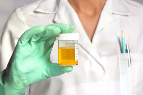 Ursachen für erhöhte Harnsäurewerte – und wie man sie senken kann