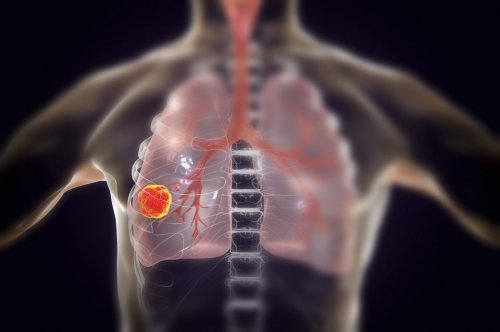 Forscher können Lungenkrebs jetzt am Atem erkennen