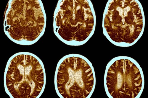 Laut Studie werden nach Corona-Infektion häufiger Alzheimer-Symptome entdeckt