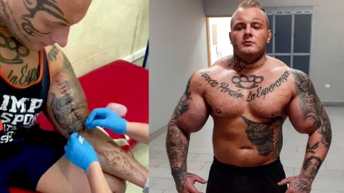 ‘Bodybuilder’ Known as ‘Polish King of Synthol’ Undergoes Gruesome Operation for 25-Inch Biceps