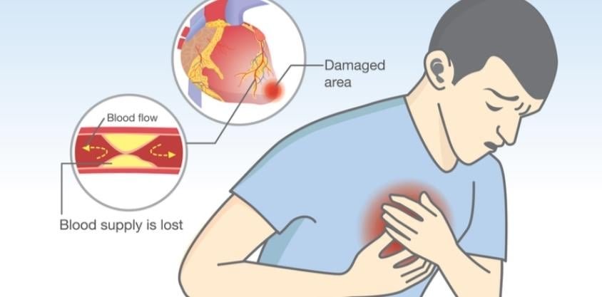 10 Foods That'll Clean Your Arteries Naturally + Protect You From Heart Attacks