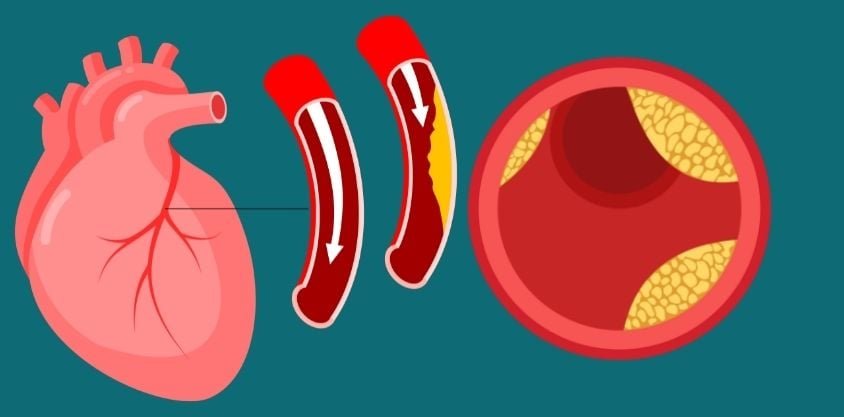 15 Foods that'll Help Lower Cholesterol Without Medication + 5 Worst Foods That'll Clog Your Arteries
