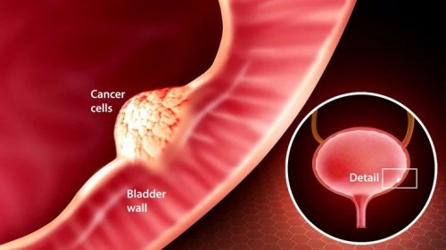 I Ignored It...: The Unexpected Symptoms That Uncovered My Bladder Cancer