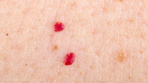 This Is Why You Have Red Marks On Your Skin (And When You Should Get Worried)